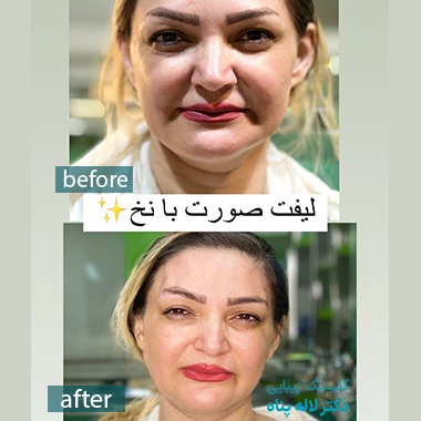 بهترین کلینیک لیفت با نخ