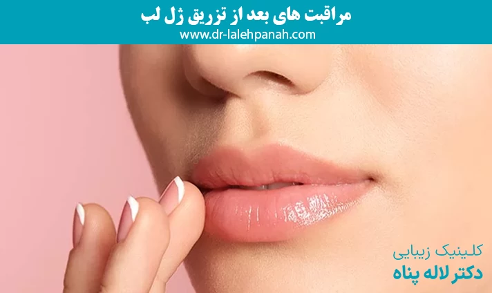 مراقبت‌ های بعد از تزریق ژل لب