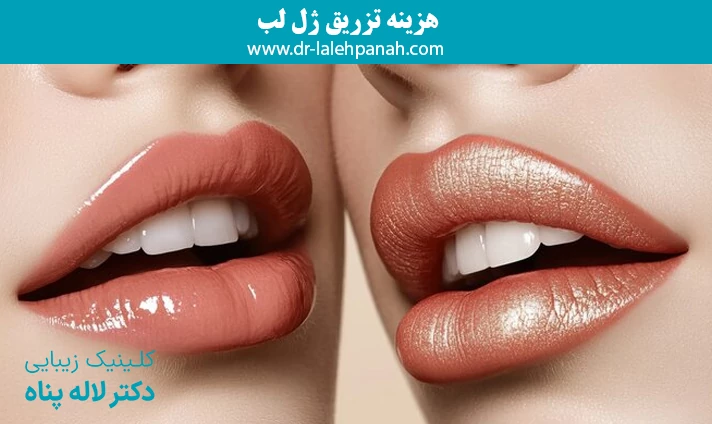 هزینه تزریق ژل لب