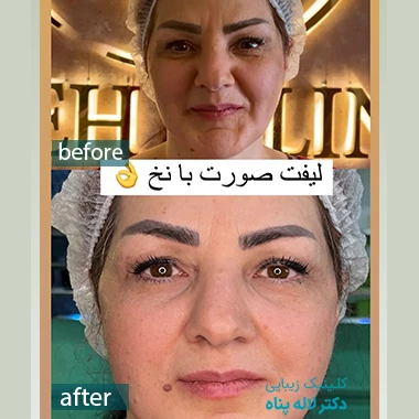 ویژگی‌های بهترین کلینیک لیفت با نخ