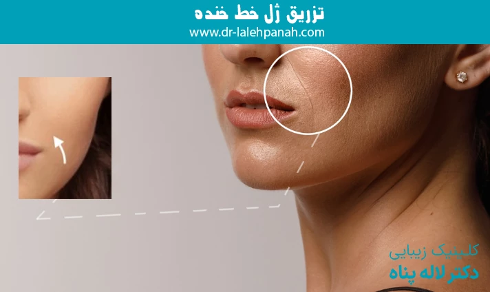تزریق ژل خط خنده