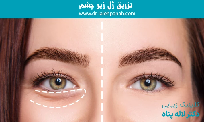تزریق ژل زیر چشم