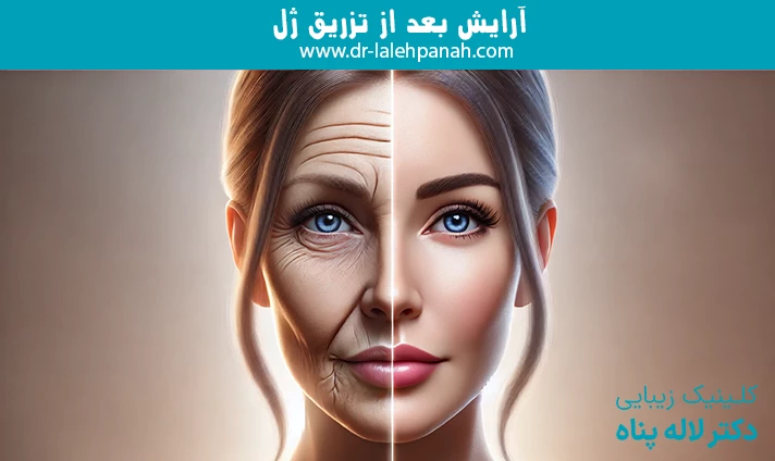 تفاوت لیفت صورت با نخ و جراحی
