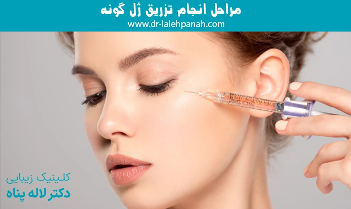 مراحل انجام تزریق ژل گونه