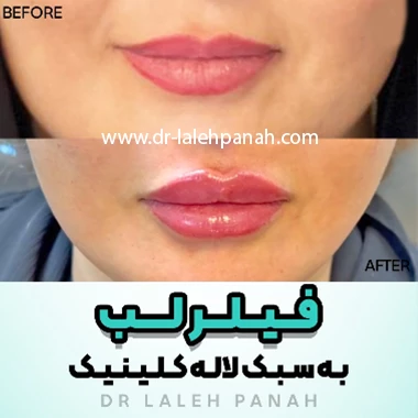 نمونه کار تزریق ژل