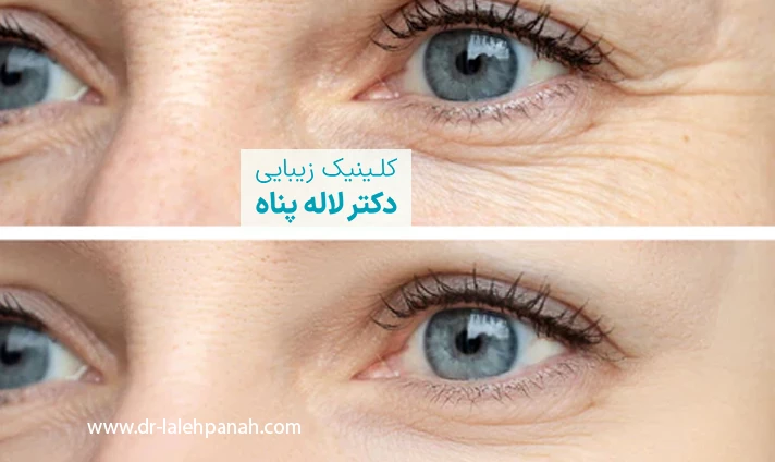 مزایای تزریق بوتاکس دور چشم