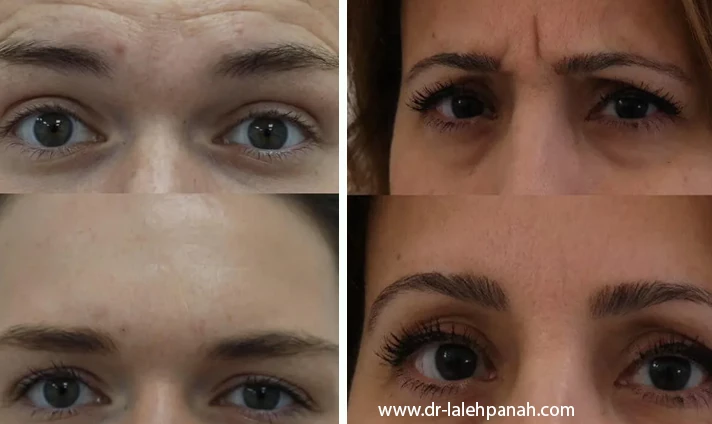 مزایای تزریق بوتاکس‌ پیشانی