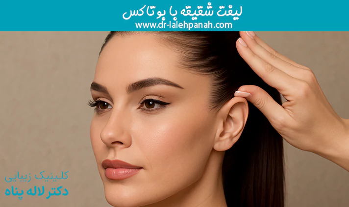 لیفت شقیقه با بوتاکس