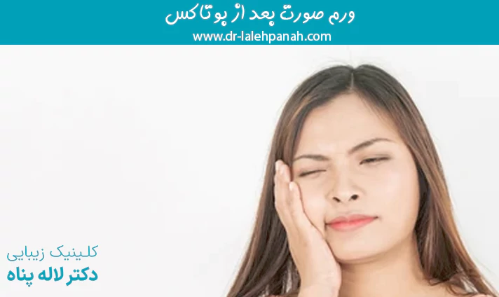 ورم صورت بعد از بوتاکس