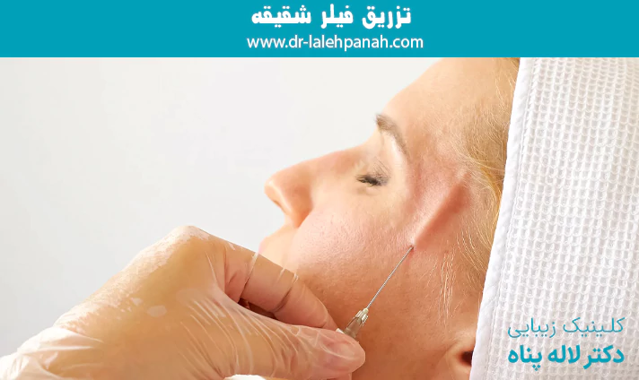 تزریق فیلر شقیقه
