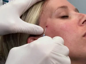 مراحل تزریق فیلر شقیقه