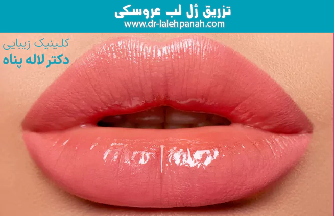 تزریق ژل لب عروسکی