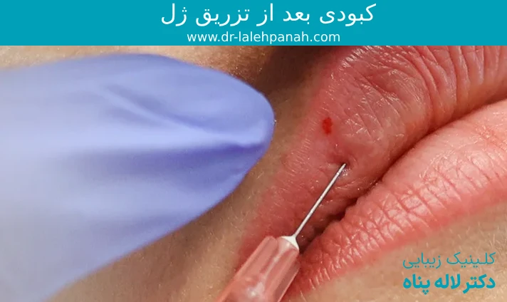 پیشگیری از کبودی بعد از تزریق ژل