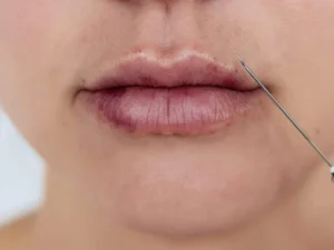 کبودی بعد از تزریق ژل