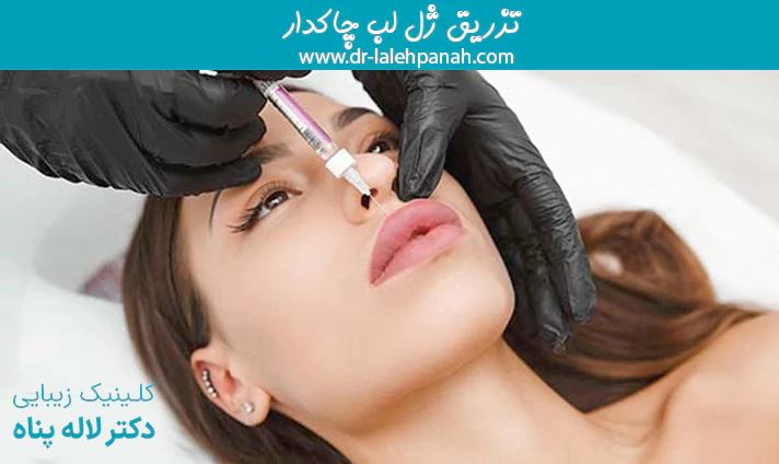 تزریق ژل لب چاکدار