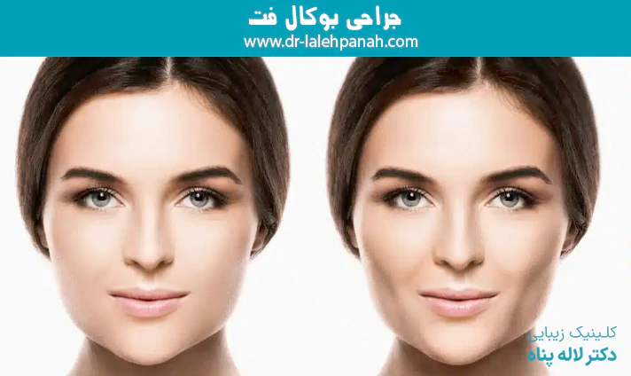جراحی بوکال فت