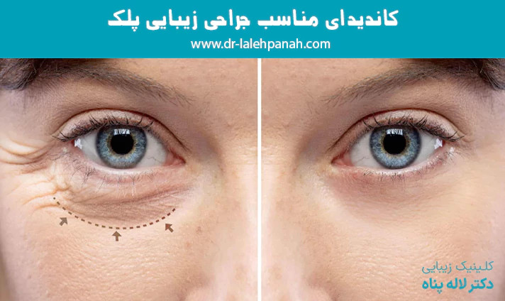 کاندیدای مناسب جراحی زیبایی پلک