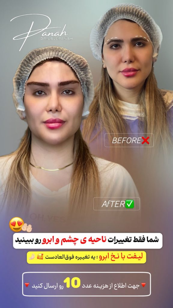 لیفت با نخ صورت