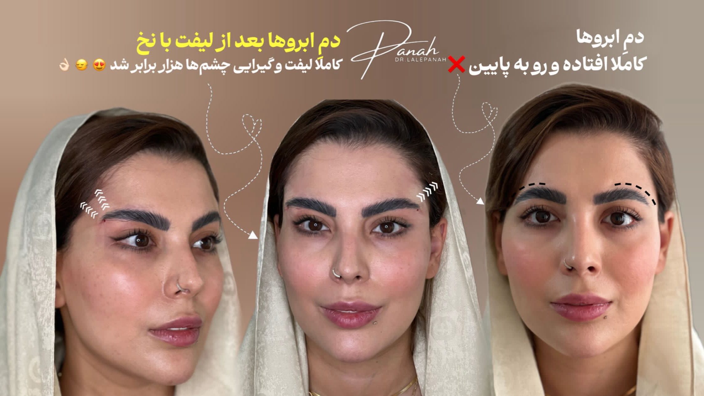 لیفت با نخ صورت